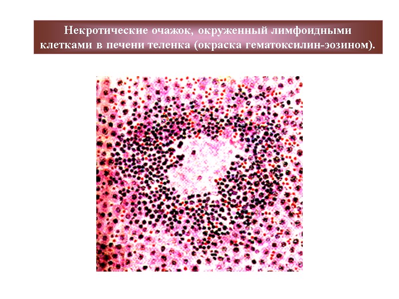 Некротические очажок, окруженный лимфоидными клетками в печени теленка (окраска гематоксилин-эозином).